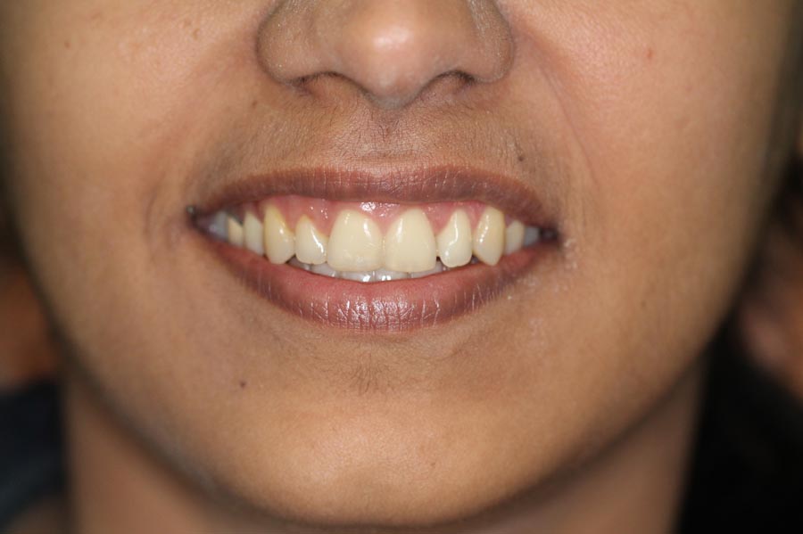 Invisalign, Braces Treatment in Mumbai