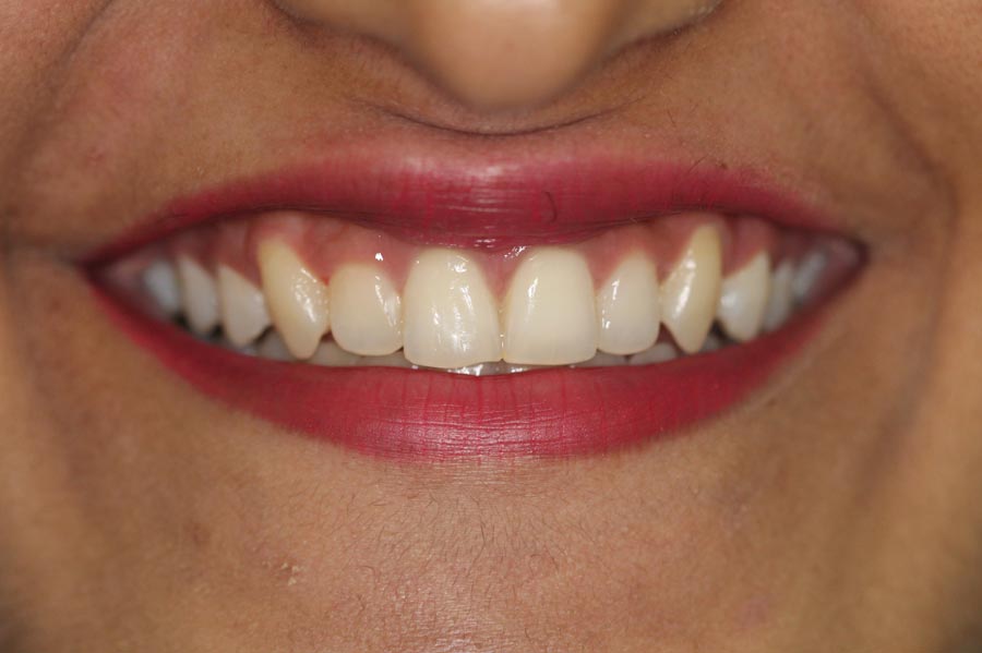 Invisalign, Braces Treatment in Mumbai