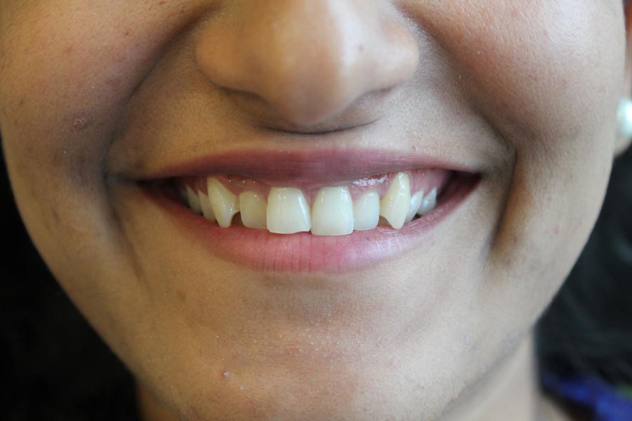 Invisalign, Braces Treatment in Mumbai