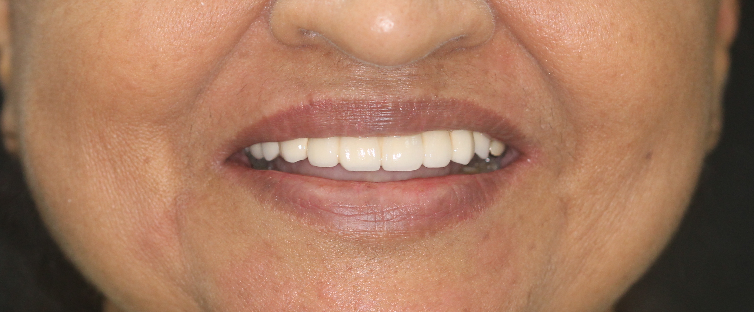 Dental Implants Treatment in Mumbai