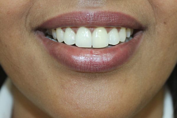 Best Gum Treatment in Mumbai