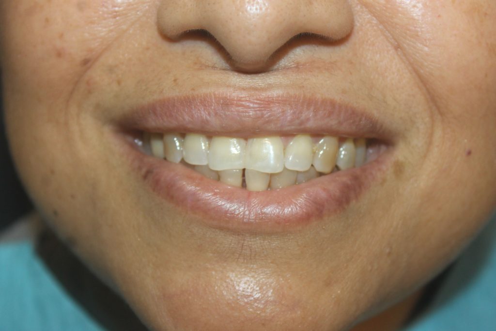 Veneers, Crowns, Bridges Treatment In Mumbai