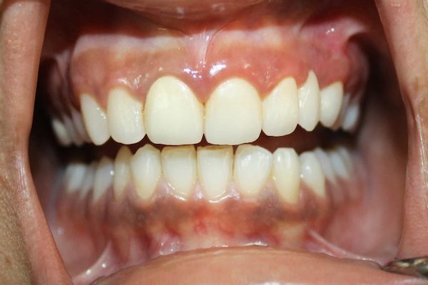 Best Teeth Whitening Treatment in Mumbai & Gum Depigmentation Treatment in Mumbai