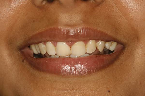 Best Gum Treatment in Mumbai