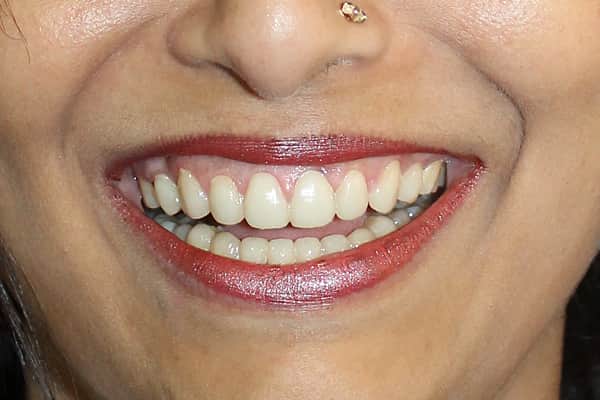 Veneers, Crowns, Bridges Treatment In Mumbai