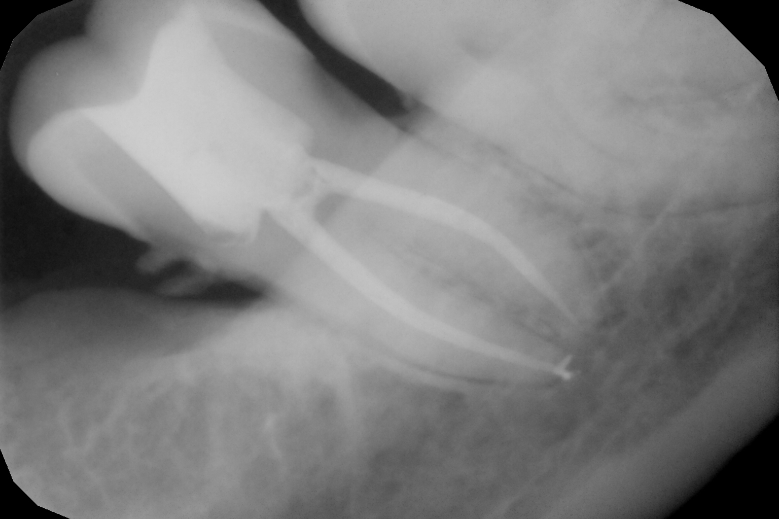 Root Canal Treatment in Mumbai