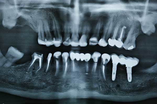 Root Canal Treatment in Mumbai