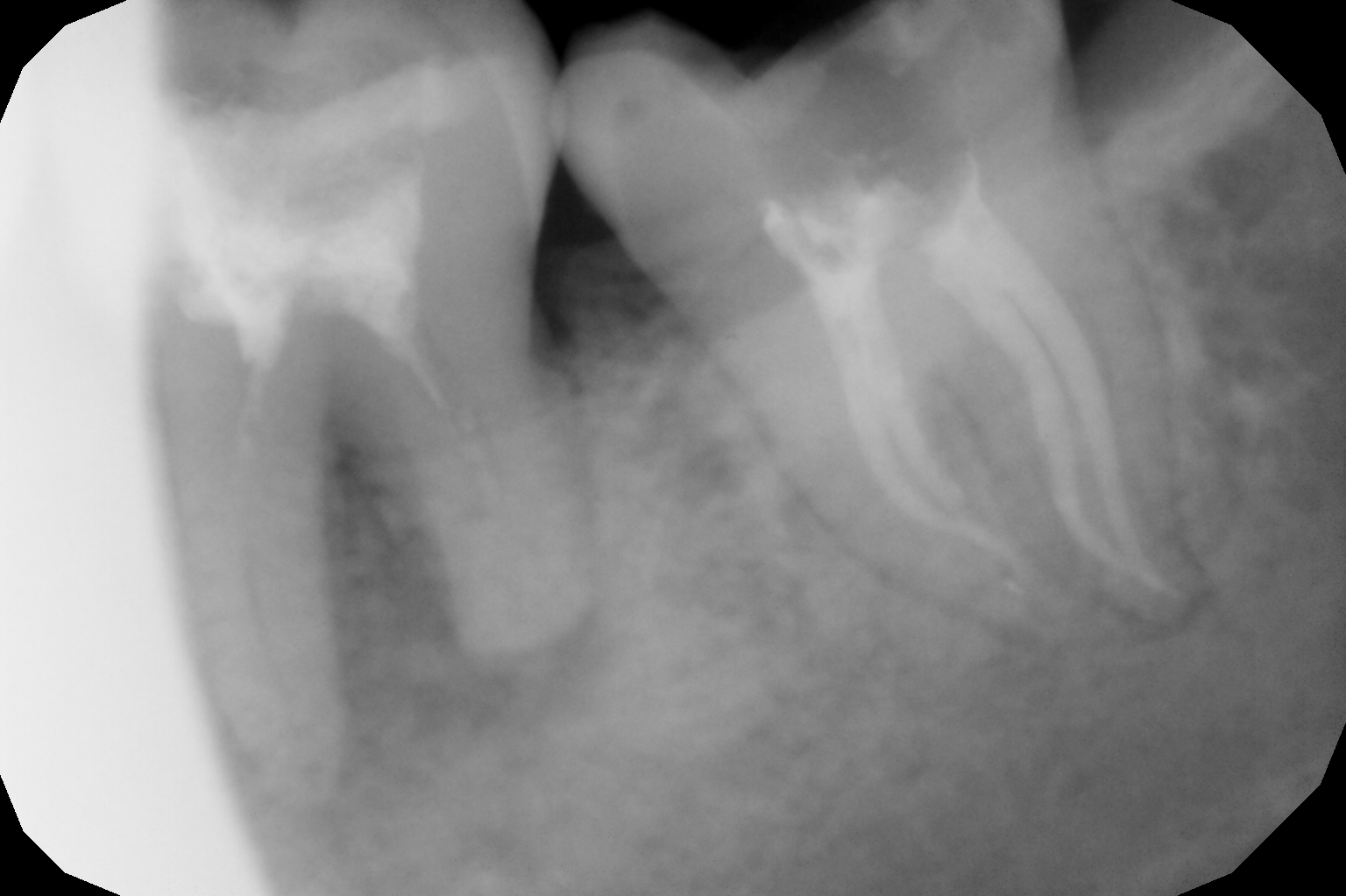 Root Canal Treatment in Mumbai