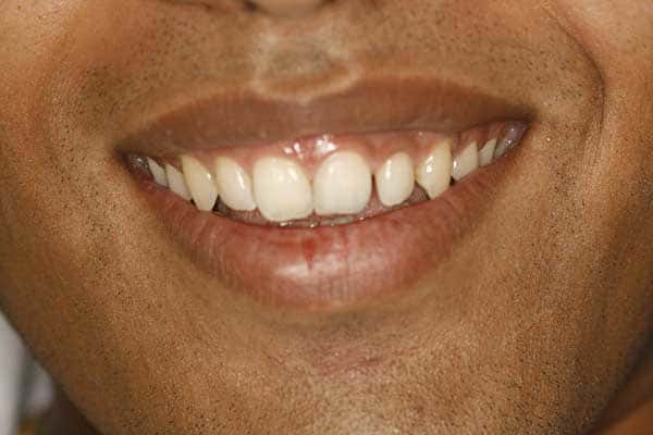 Veneers, Crowns, Bridges Treatment In Mumbai