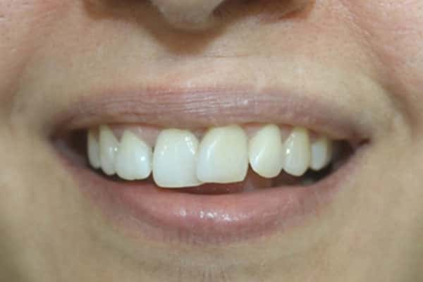 Veneers, Crowns, Bridges Treatment In Mumbai