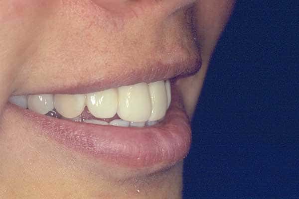 Veneers, Crowns, Bridges Treatment In Mumbai