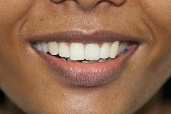 Veneers, Crowns, Bridges Treatment In Mumbai