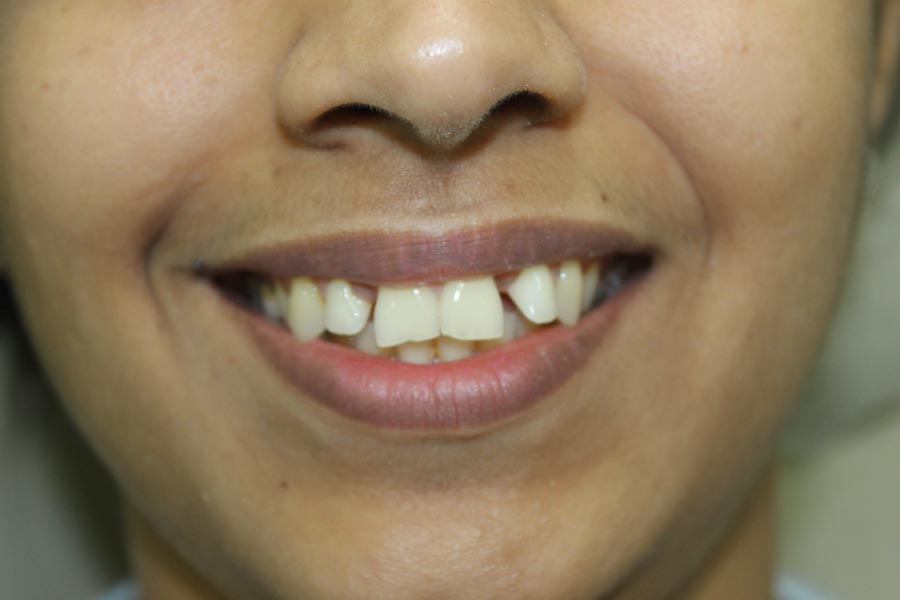 Invisalign, Braces Treatment in Mumbai