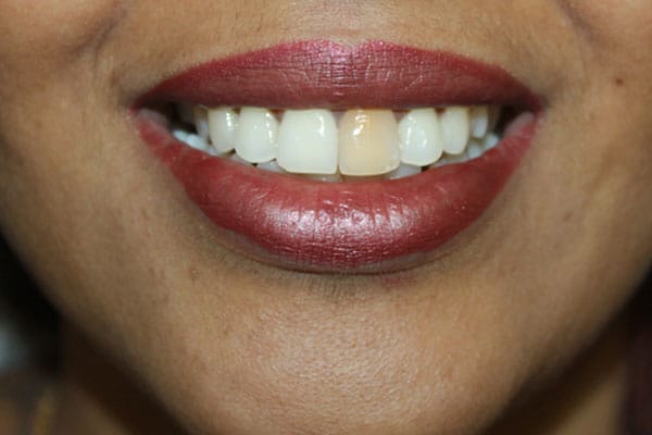 Veneers, Crowns, Bridges Treatment In Mumbai