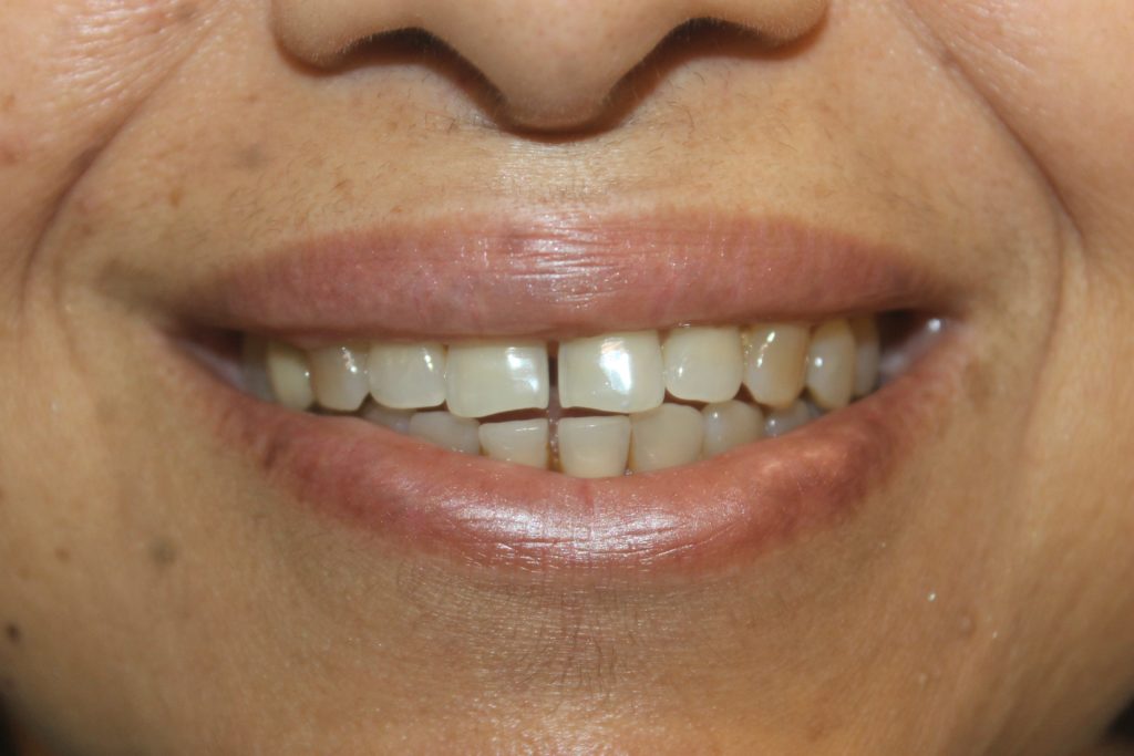 Veneers, Crowns, Bridges Treatment In Mumbai