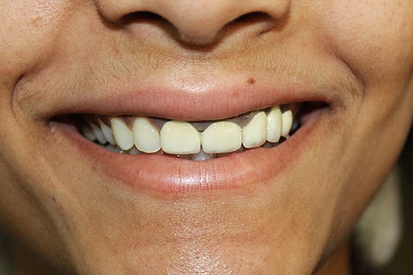 Best Teeth Whitening Treatment in Mumbai & Gum Depigmentation Treatment in Mumbai