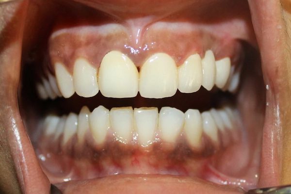 Best Teeth Whitening Treatment in Mumbai & Gum Depigmentation Treatment in Mumbai