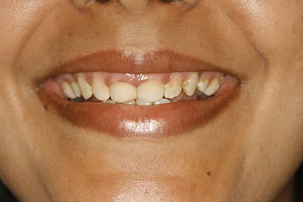 Veneers, Crowns, Bridges Treatment In Mumbai