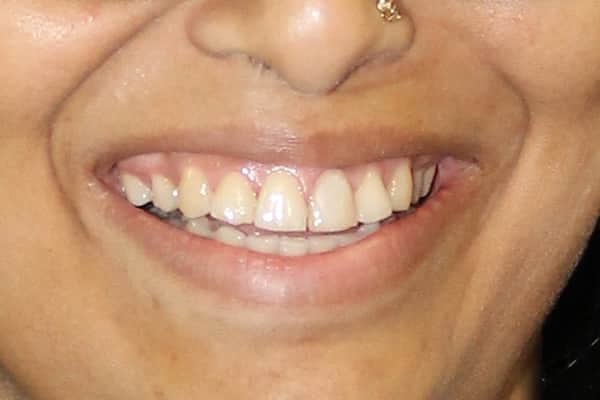 Veneers, Crowns, Bridges Treatment In Mumbai