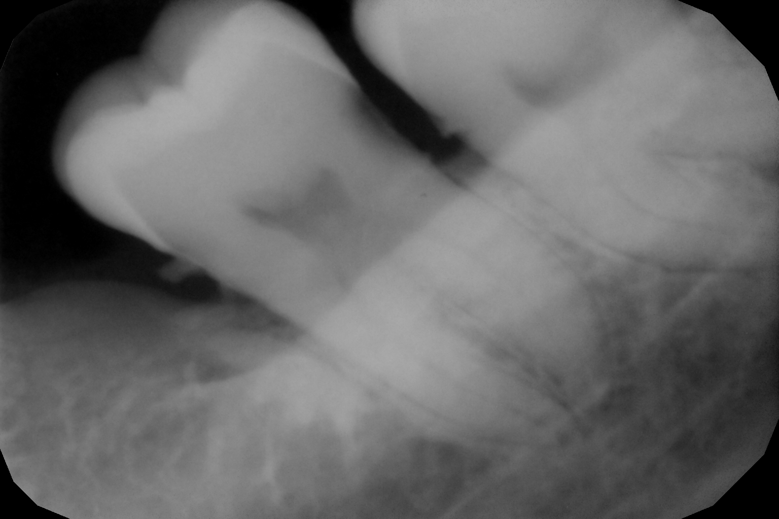 Root Canal Treatment in Mumbai