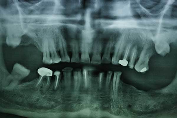 Root Canal Treatment in Mumbai