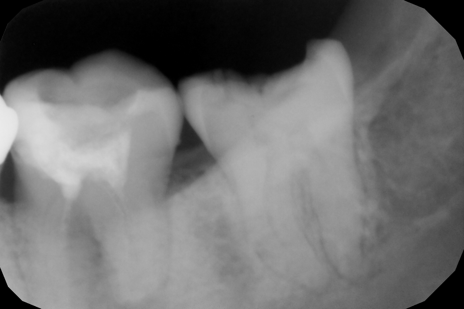 Root Canal Treatment in Mumbai