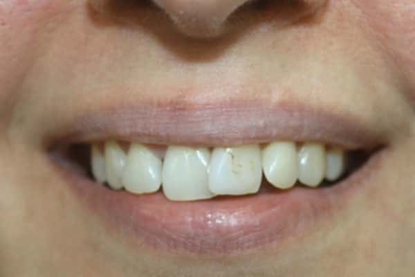 Veneers, Crowns, Bridges Treatment In Mumbai