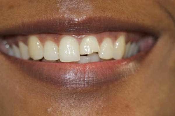 Veneers, Crowns, Bridges Treatment In Mumbai