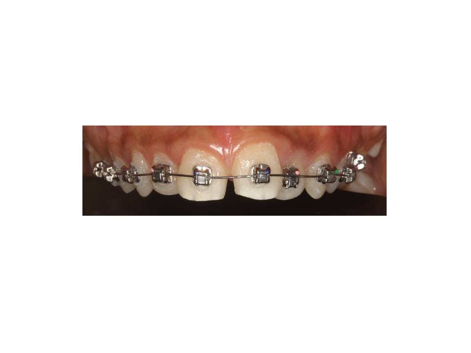 Invisalign, Braces Treatment in Mumbai