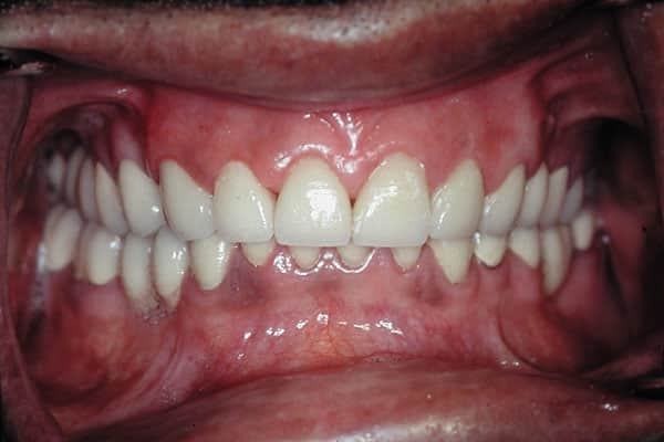 Full Mouth Rehabilitation Treatment in Mumbai