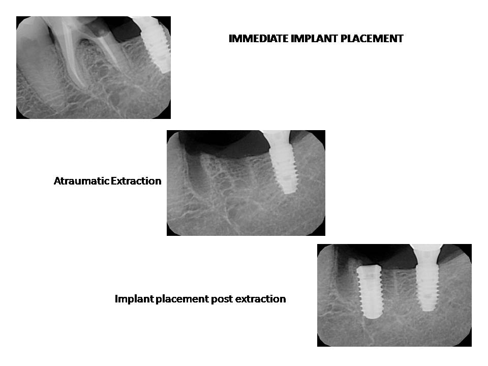 Dental Implants Treatment in Mumbai