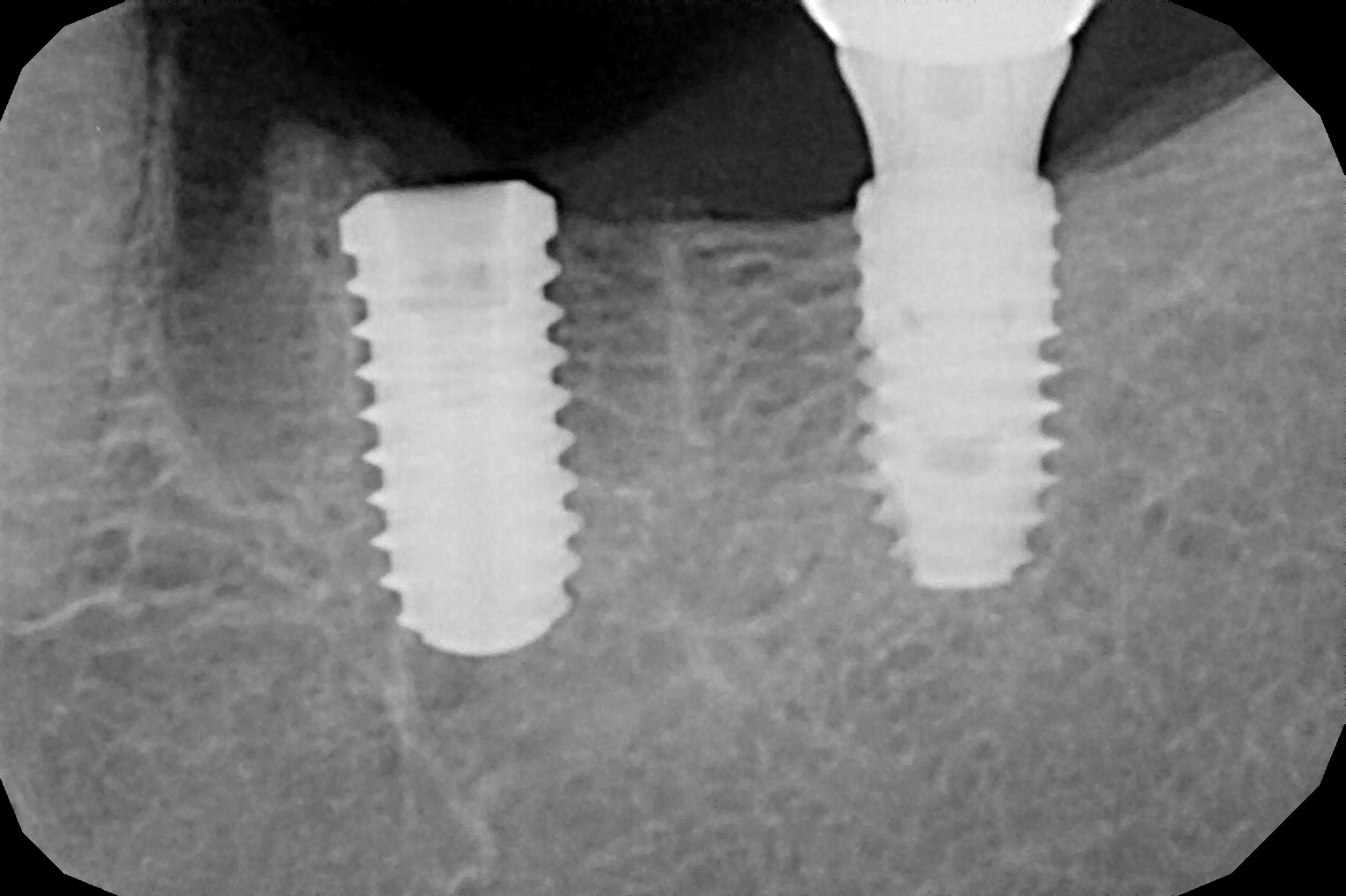 Dental Implants Treatment in Mumbai