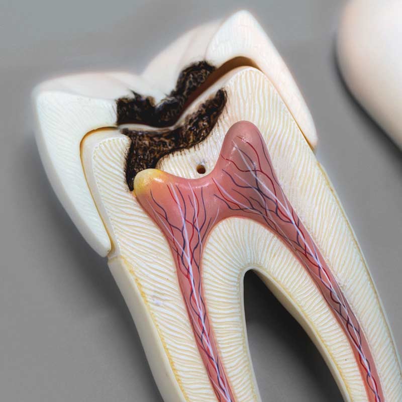 Root Canal Treatment in Mumbai